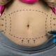 Tummy tuck Tunisie : retrouver un ventre plat